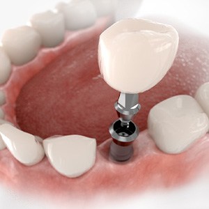 Digital image of the dental implant parts