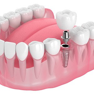 Illustration of a single dental implant