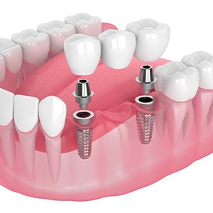 Illustration of an implant bridge