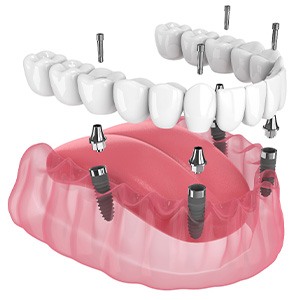 Illustration of an implant denture