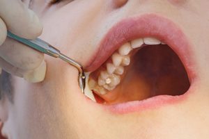 Closeup mouth during exam showing a tooth colored filling